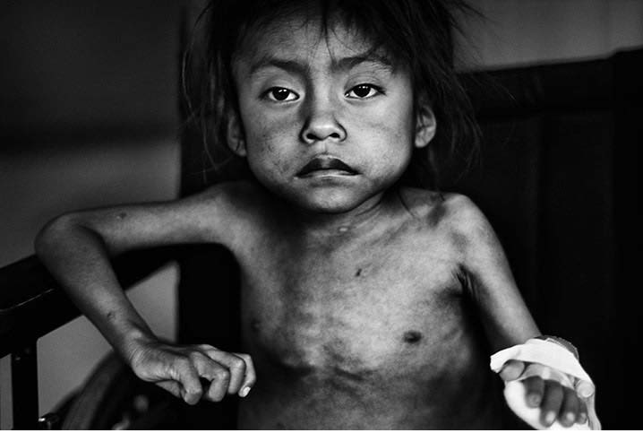 Παιδί στην Ασία, σκελετωμένο και άρρωστο από την έλλειψη φαγητού
