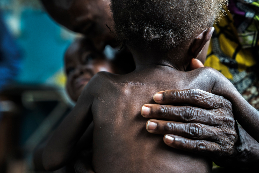 Λαϊκή Δημοκρατία Κονγκό: Τα υποσιτισμένα δίδυμα ηλικίας 17 μηνών έφτασαν στο κέντρο υγείας της Ντιτεκεμένα με τους παππούδες τους. Κρύβονταν στο δάσος επί πέντε μήνες, όταν ένοπλοι επιτέθηκαν στα χωριά. Οι γονείς τους σκοτώθηκαν και τα μωρά έχουν εμφανή στο σώμα τους τραύματα από μαχαίρι. (Σεπτέμβριος 2017) πηγη: Marta Soszynska/MSF
