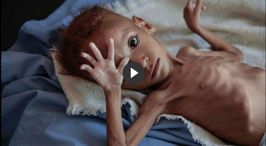 Yemen Health Ministry A child dies every 10 minutes